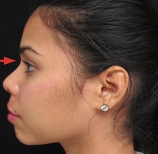 Liquid Rhinoplasty Before & After Gallery - Patient 122908659 - Image 2