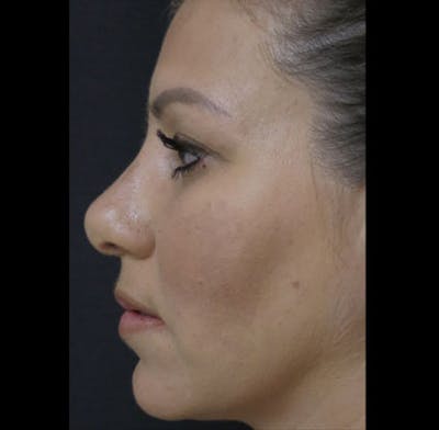 Revision Rhinoplasty Before & After Gallery - Patient 122908662 - Image 1