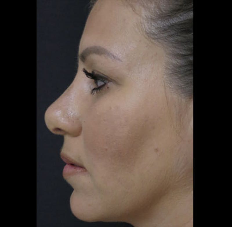 Revision Rhinoplasty Before & After Gallery - Patient 122908662 - Image 1