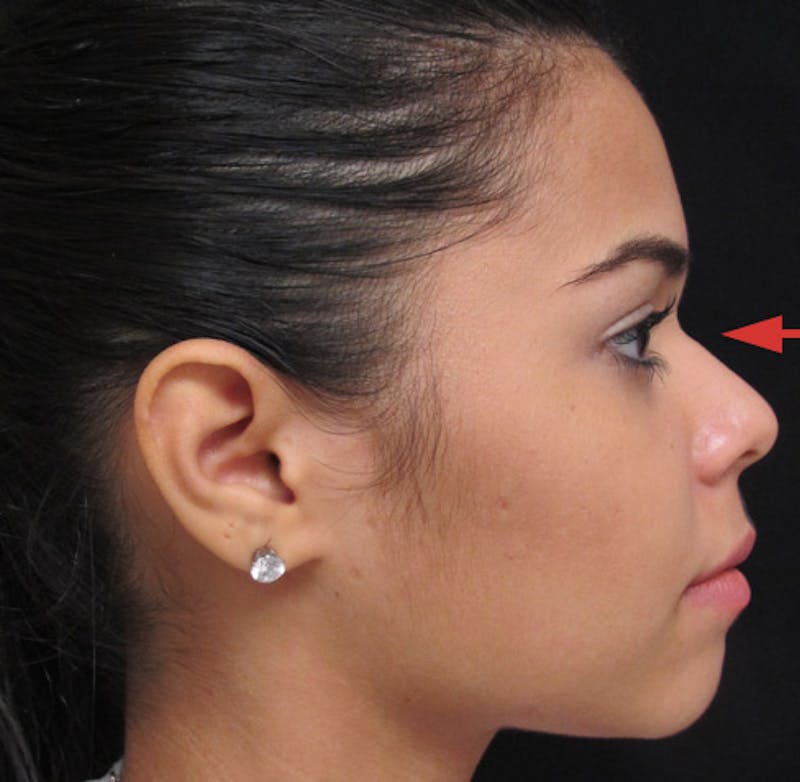 Liquid Rhinoplasty Before & After Gallery - Patient 122908659 - Image 3