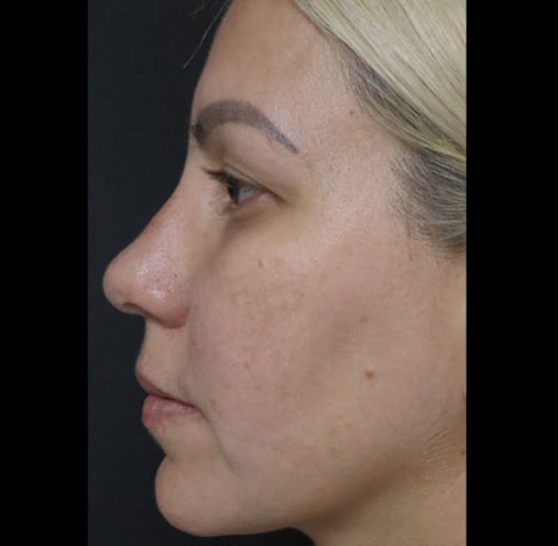 Revision Rhinoplasty