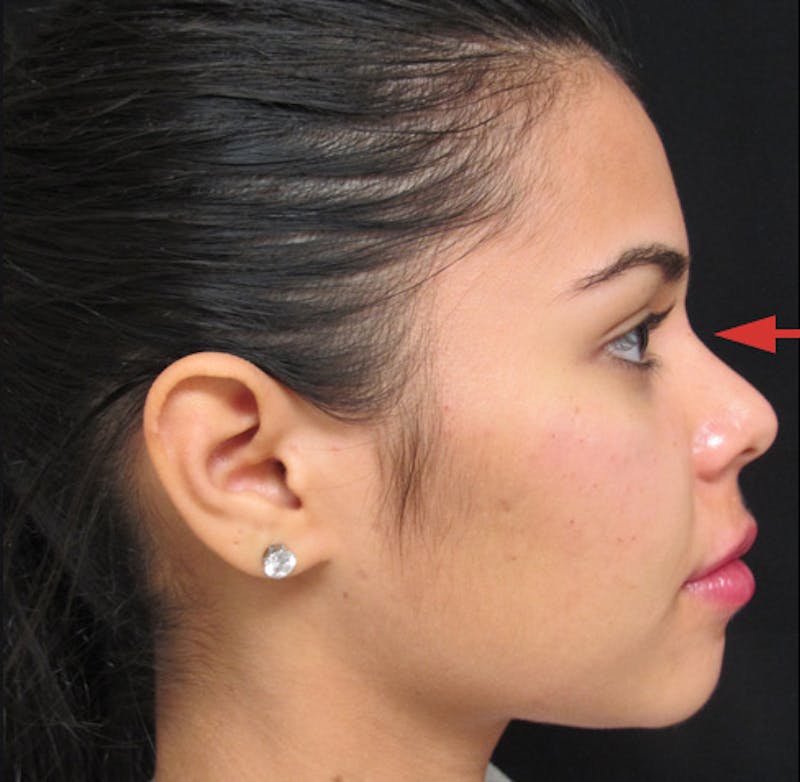 Liquid Rhinoplasty Before & After Gallery - Patient 122908659 - Image 4