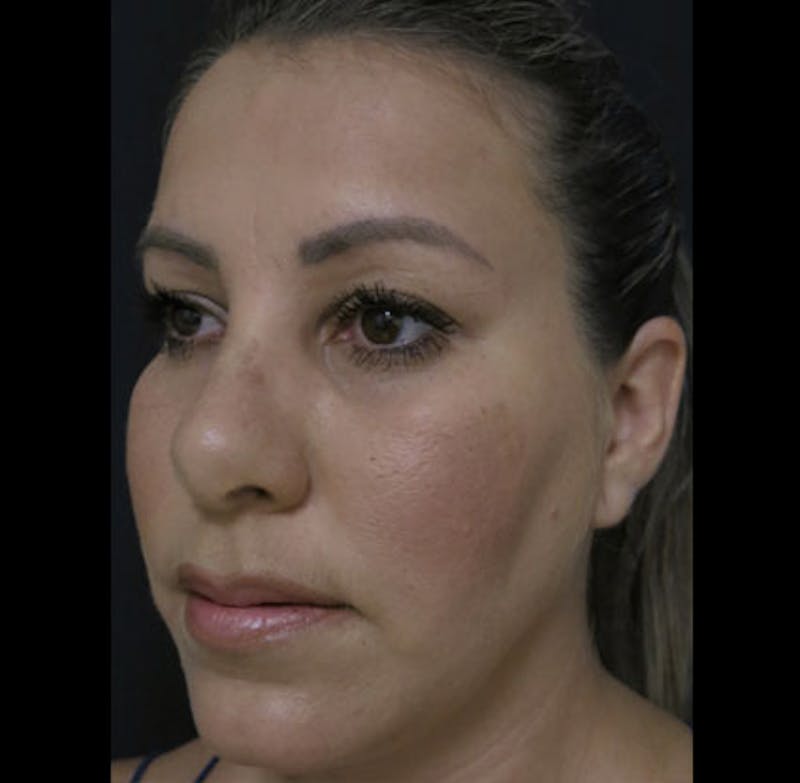 Revision Rhinoplasty Before & After Gallery - Patient 122908662 - Image 3