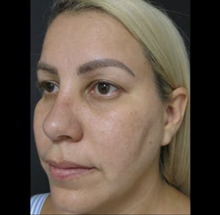 Revision Rhinoplasty Before & After Gallery - Patient 122908662 - Image 4
