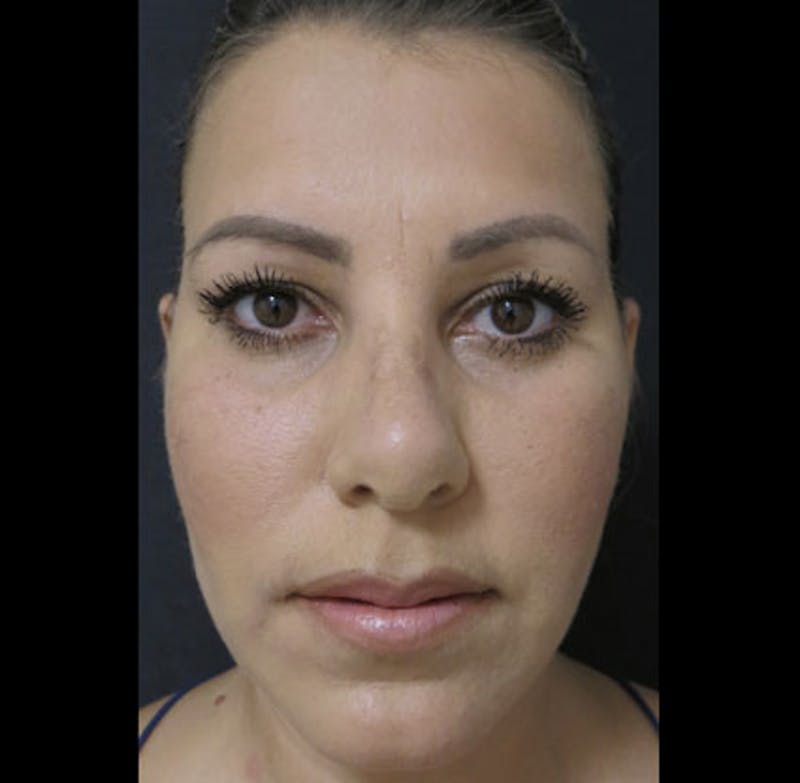 Revision Rhinoplasty Before & After Gallery - Patient 122908662 - Image 5