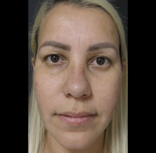 Revision Rhinoplasty Before & After Gallery - Patient 122908662 - Image 6