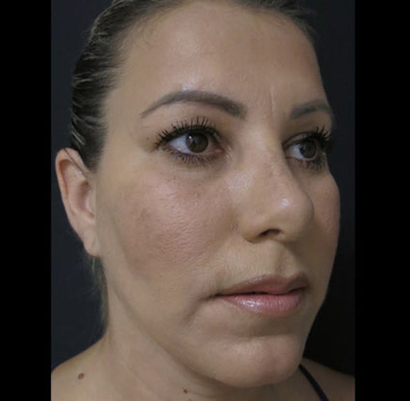 Revision Rhinoplasty Before & After Gallery - Patient 122908662 - Image 7