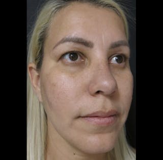 Revision Rhinoplasty Before & After Gallery - Patient 122908662 - Image 8