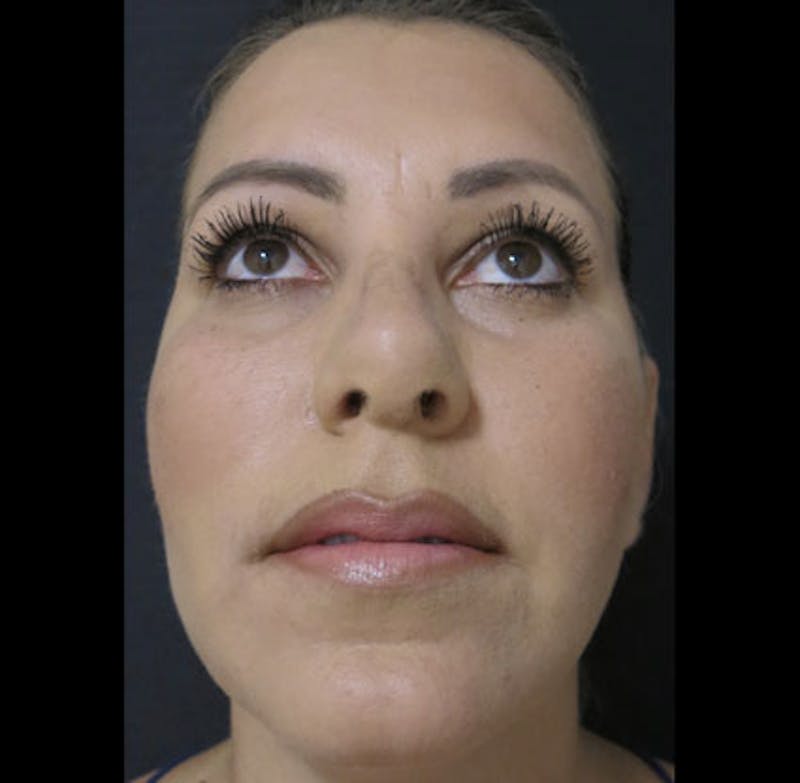 Revision Rhinoplasty Before & After Gallery - Patient 122908662 - Image 9