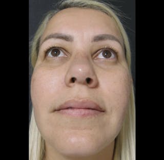 Revision Rhinoplasty Before & After Gallery - Patient 122908662 - Image 10