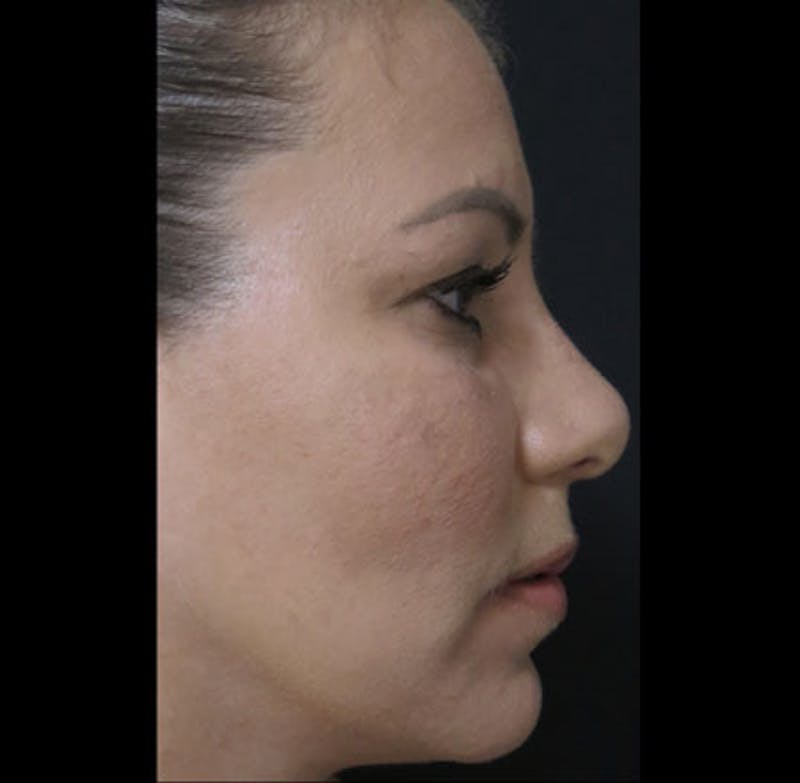 Revision Rhinoplasty Before & After Gallery - Patient 122908662 - Image 11