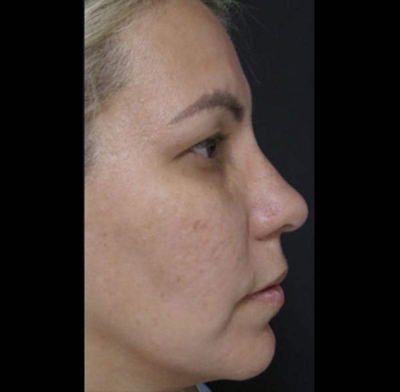 Revision Rhinoplasty Before & After Gallery - Patient 122908662 - Image 12