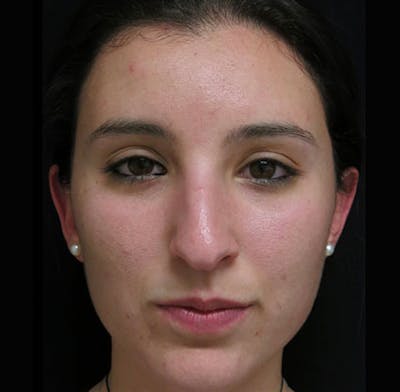 Nasal Fracture Before & After Gallery - Patient 122908673 - Image 1
