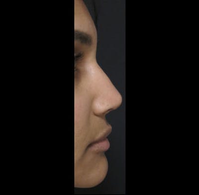 Revision Rhinoplasty Before & After Gallery - Patient 122908669 - Image 2
