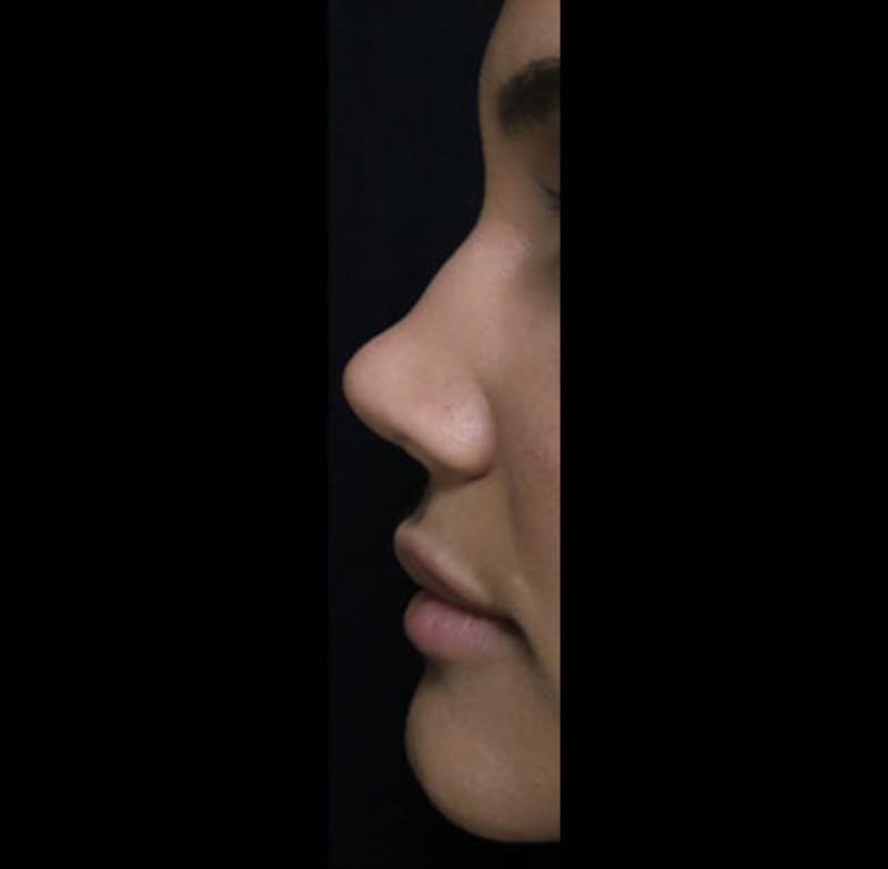 Revision Rhinoplasty Before & After Gallery - Patient 122908669 - Image 3