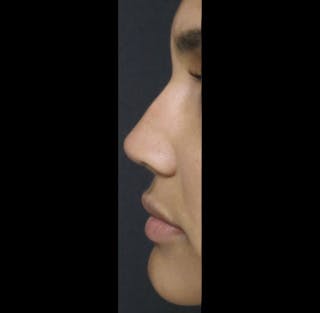 Revision Rhinoplasty Before & After Gallery - Patient 122908669 - Image 4