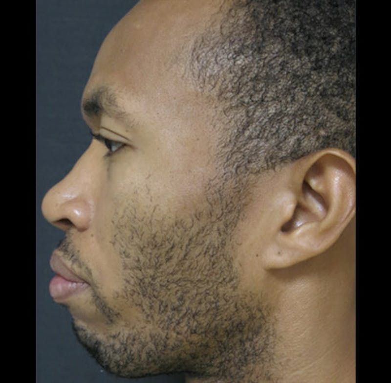 Revision Rhinoplasty Before & After Gallery - Patient 122908675 - Image 1