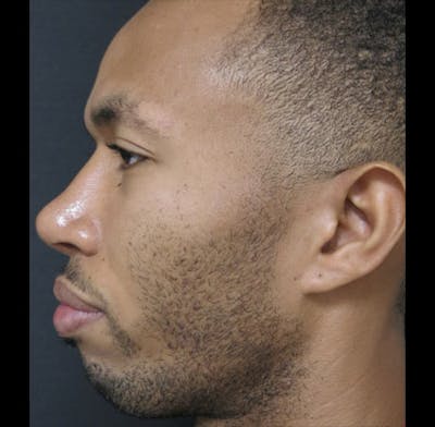 Revision Rhinoplasty Before & After Gallery - Patient 122908675 - Image 2
