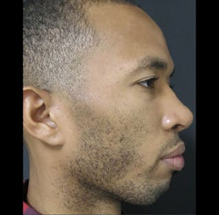 Revision Rhinoplasty Before & After Gallery - Patient 122908675 - Image 12