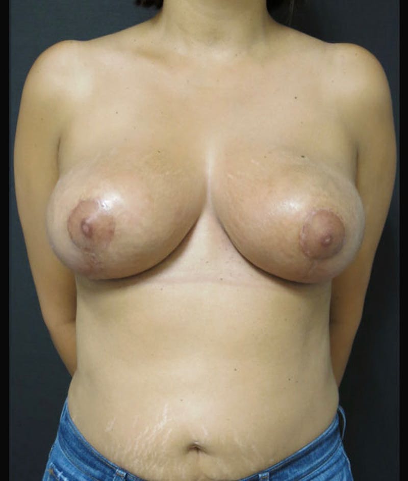 Breast Reduction Before & After Gallery - Patient 122908739 - Image 2