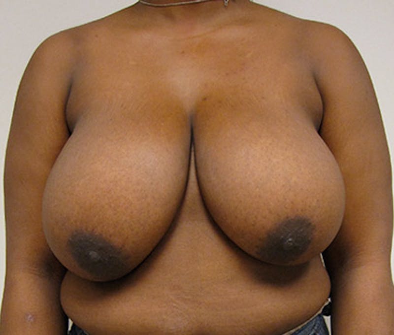 Breast Reduction Before & After Gallery - Patient 122908742 - Image 1