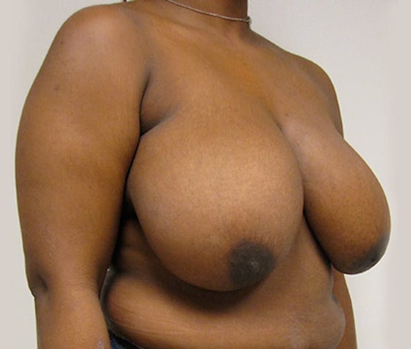 Breast Reduction Before & After Gallery - Patient 122908742 - Image 5