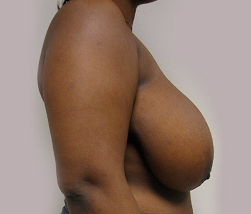 Breast Reduction Before & After Gallery - Patient 122908742 - Image 7