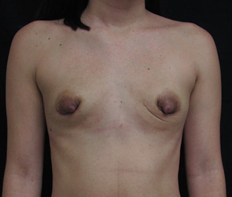 Breast Revision Before & After Gallery - Patient 122908745 - Image 1