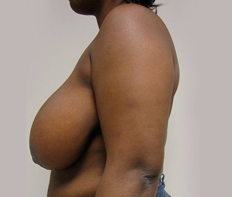 Breast Reduction Before & After Gallery - Patient 122908742 - Image 11