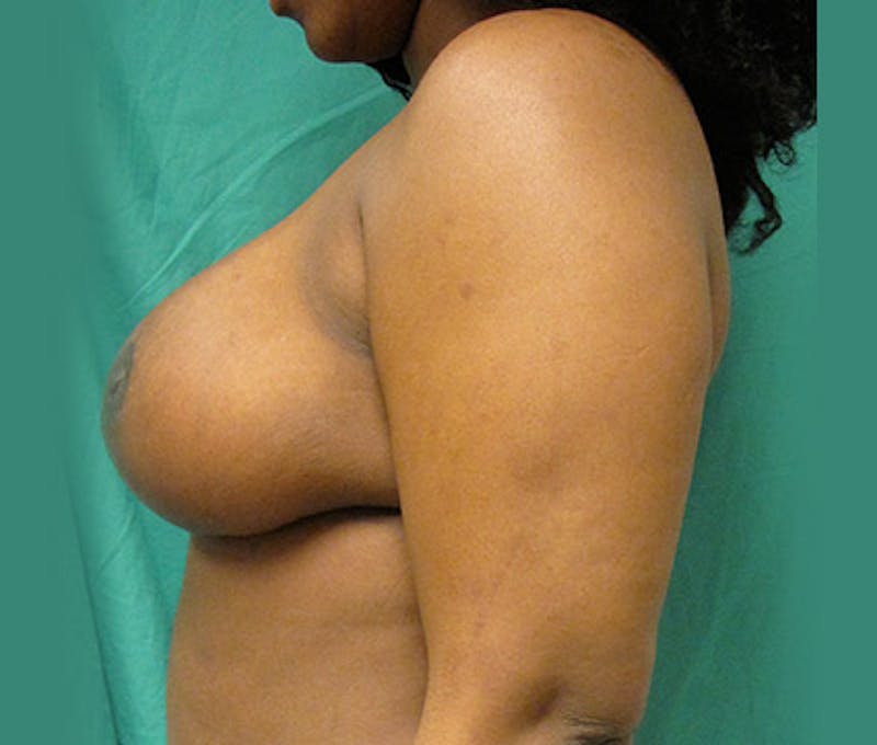 Breast Reduction Before & After Gallery - Patient 122908742 - Image 12