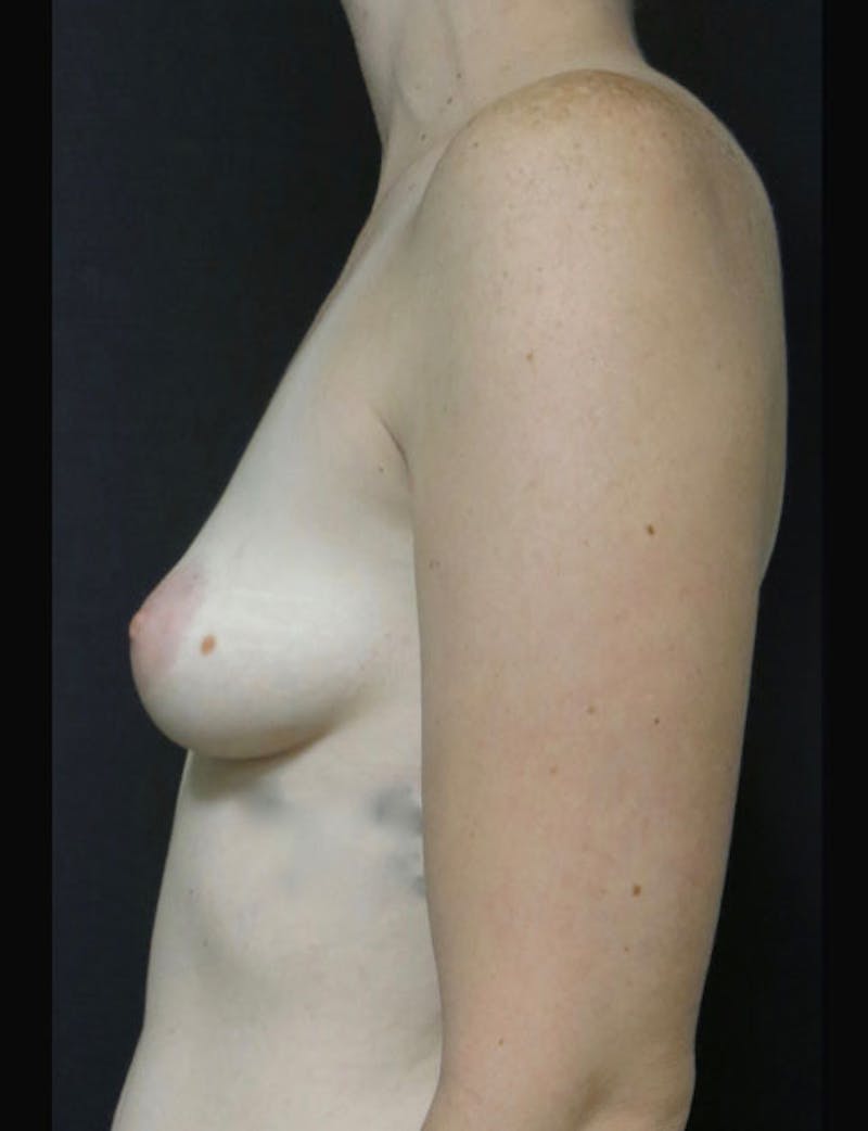 Breast Augmentation Before & After Gallery - Patient 122908744 - Image 7