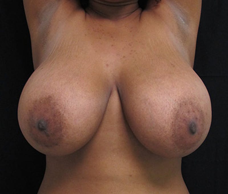 Breast Reduction Before & After Gallery - Patient 122908748 - Image 3