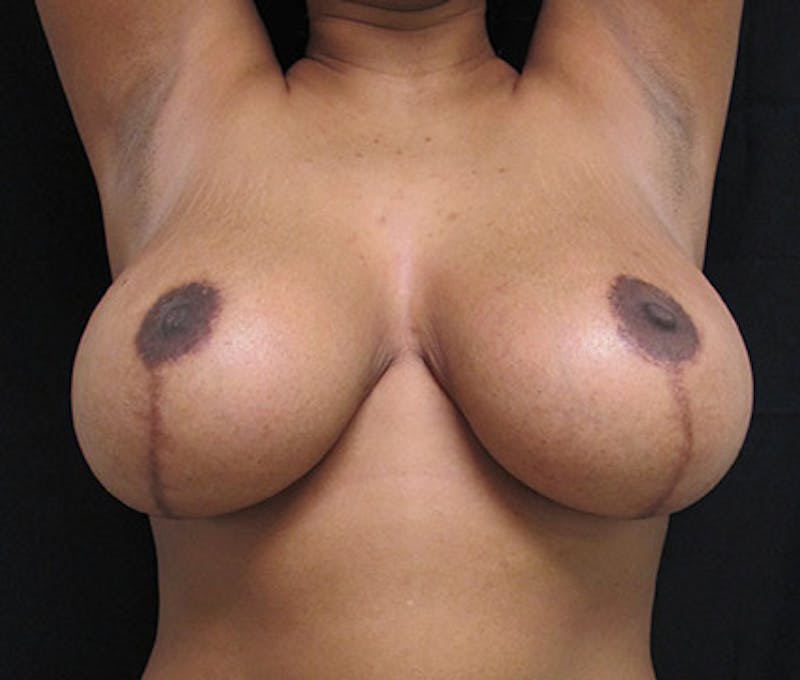 Breast Reduction Before & After Gallery - Patient 122908748 - Image 4