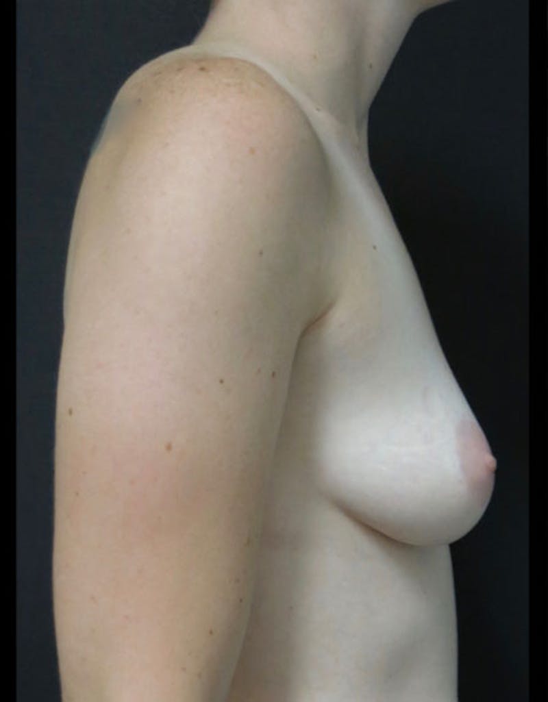 Breast Augmentation Before & After Gallery - Patient 122908744 - Image 9