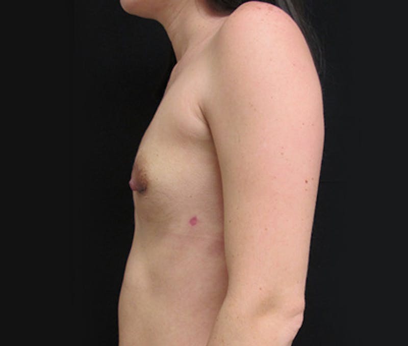 Breast Revision Before & After Gallery - Patient 122908745 - Image 9