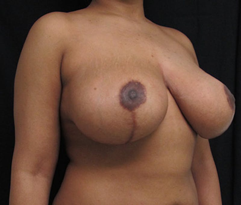 Breast Reduction Before & After Gallery - Patient 122908748 - Image 6