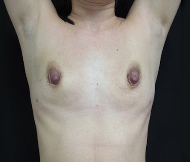 Breast Revision Before & After Gallery - Patient 122908745 - Image 11