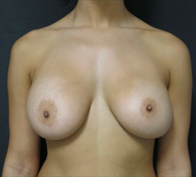 Breast Revision Before & After Gallery - Patient 122908775 - Image 1