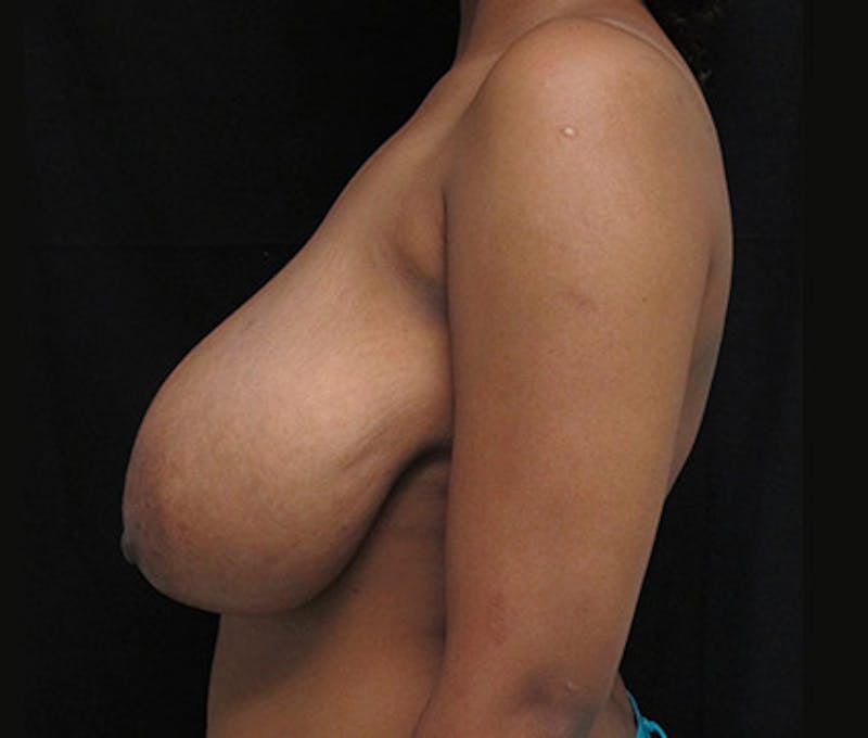 Breast Reduction Before & After Gallery - Patient 122908748 - Image 11