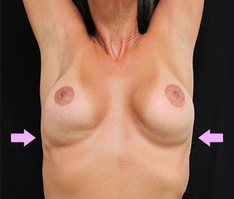 Breast Revision Before & After Gallery - Patient 122908781 - Image 3