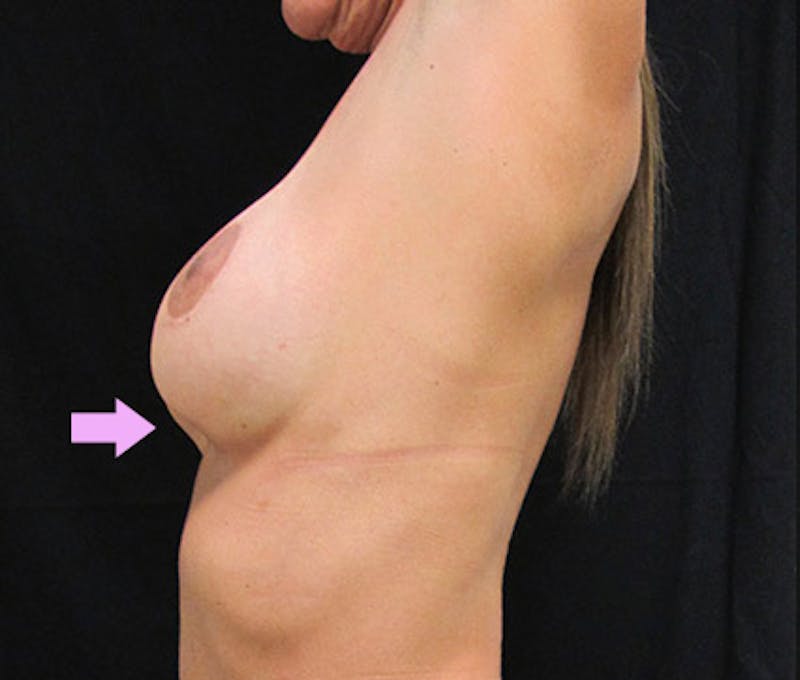 Breast Revision Before & After Gallery - Patient 122908781 - Image 15