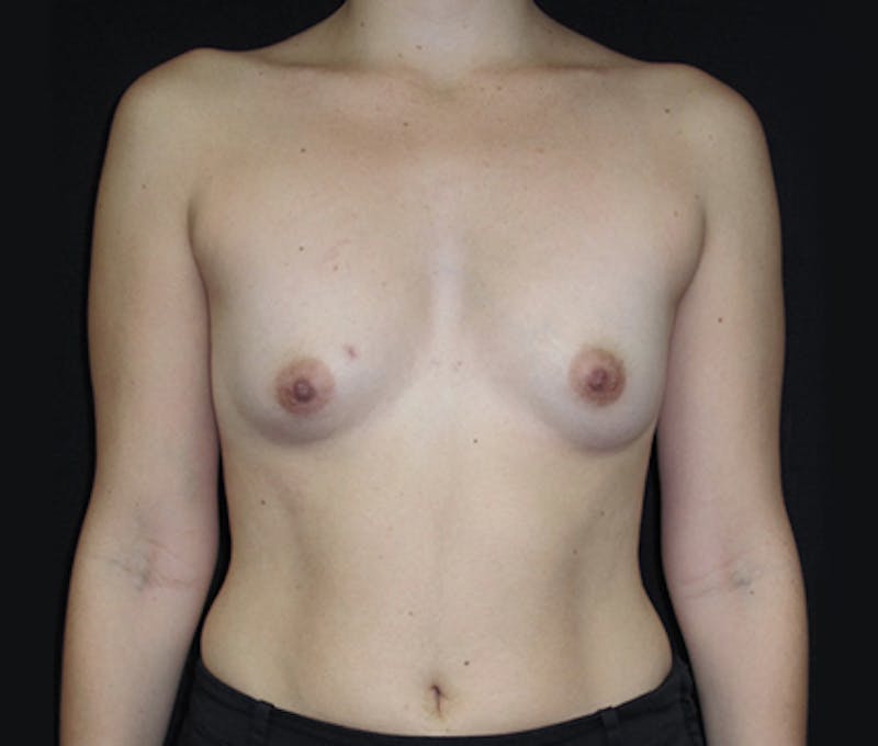 Breast Augmentation Before & After Gallery - Patient 122908787 - Image 1