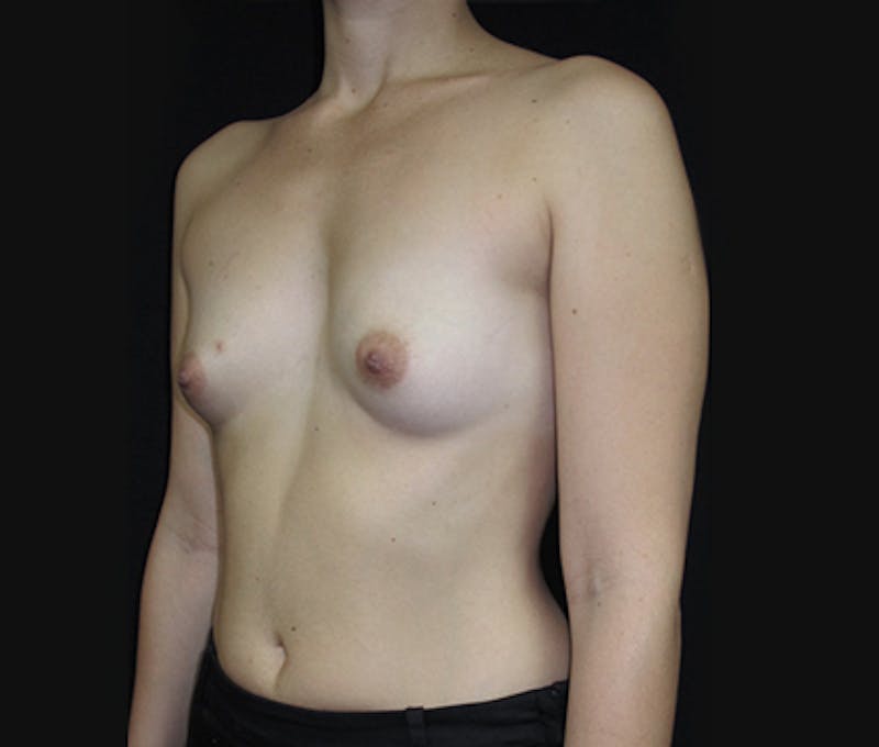 Breast Augmentation Before & After Gallery - Patient 122908787 - Image 3