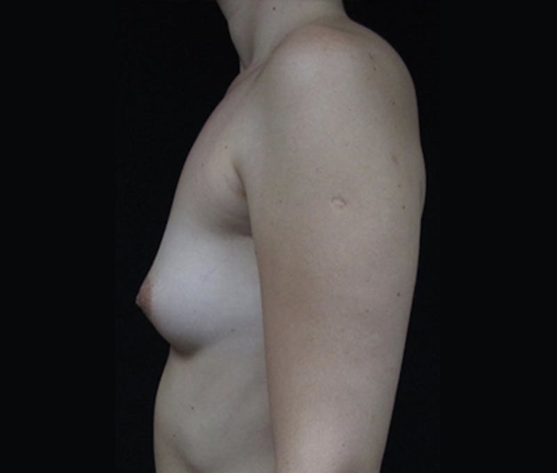Breast Augmentation Before & After Gallery - Patient 122908787 - Image 5