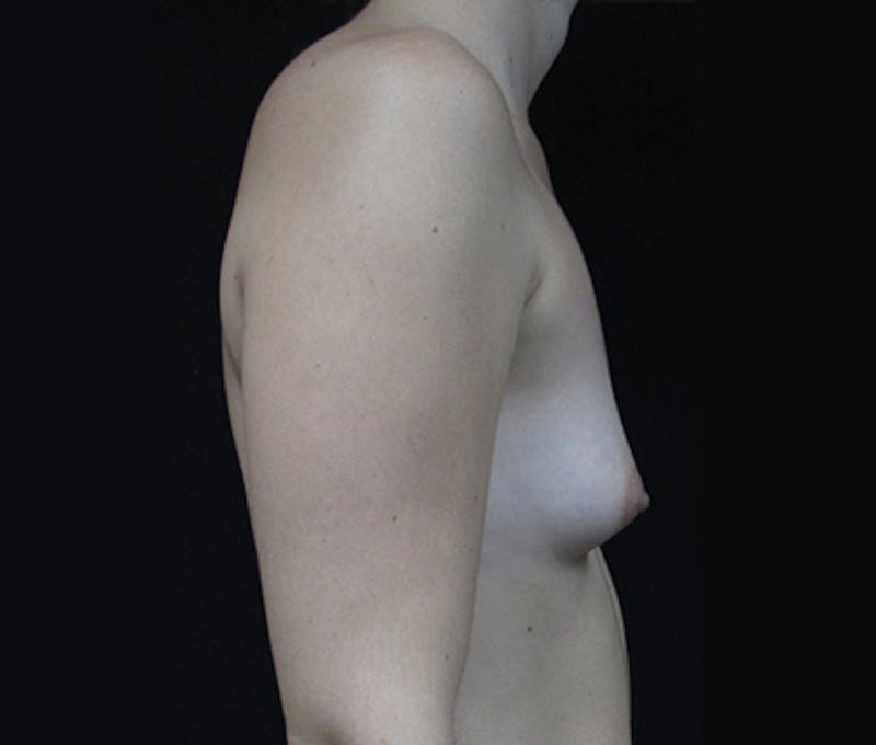 Breast Augmentation Before & After Gallery - Patient 122908787 - Image 7