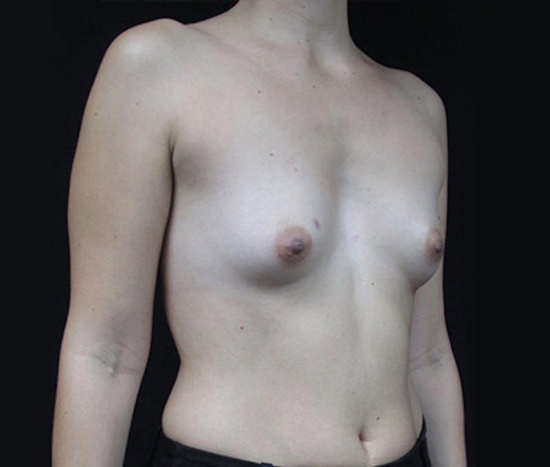 Breast Augmentation Before & After Gallery - Patient 122908787 - Image 9