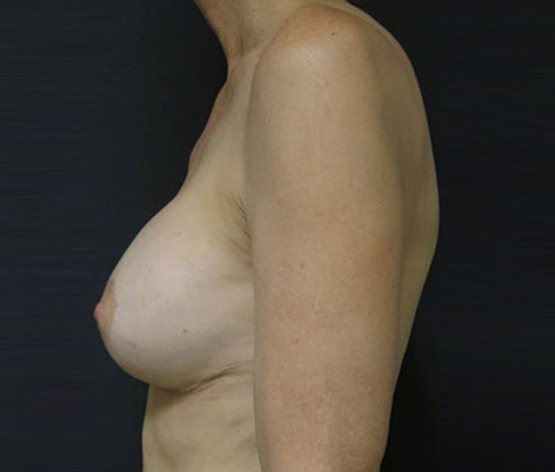 Breast Revision Before & After Gallery - Patient 122908788 - Image 10