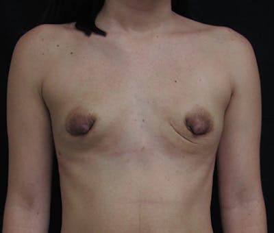 Breast Augmentation Before & After Gallery - Patient 122908793 - Image 1