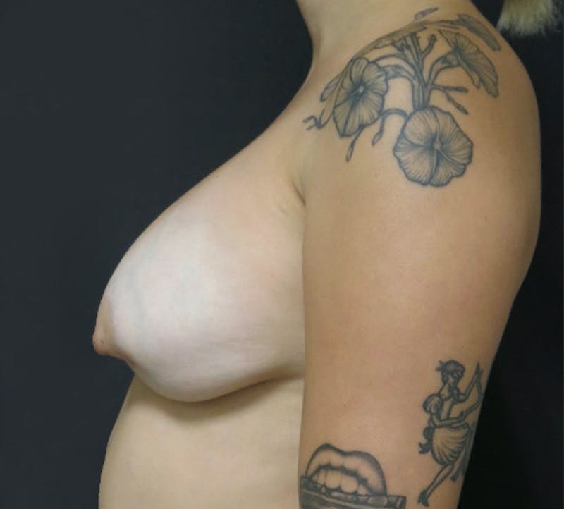 Breast Revision Before & After Gallery - Patient 122908792 - Image 7