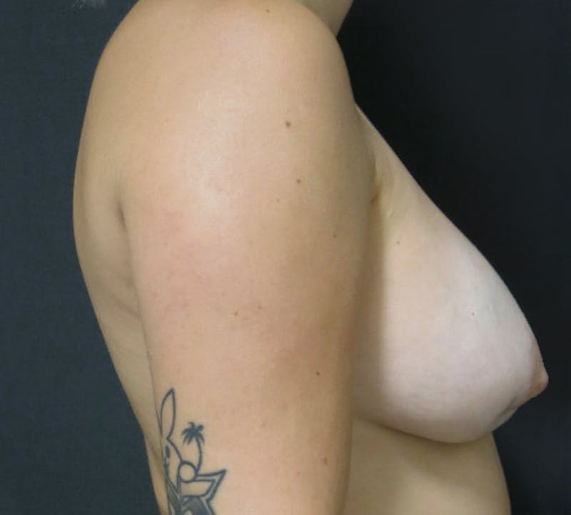 Breast Revision Before & After Gallery - Patient 122908792 - Image 9